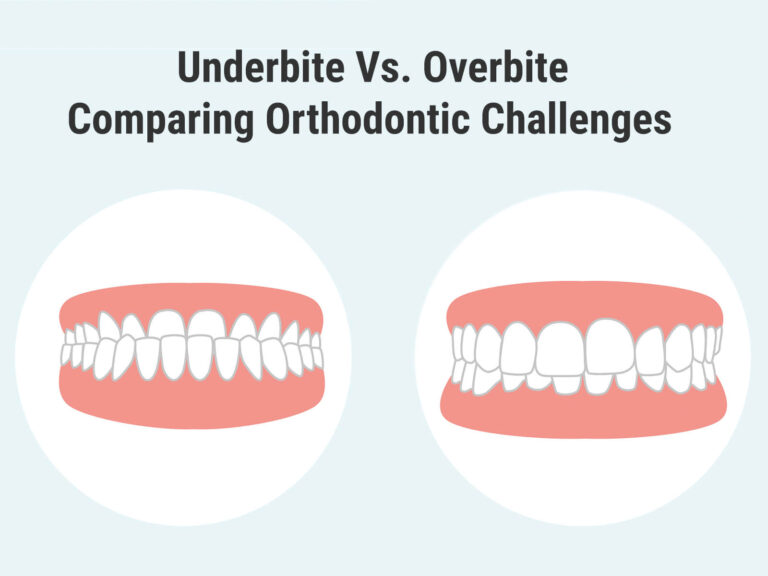 Differentiating Major Bite Problems Overbite Vs Underbite