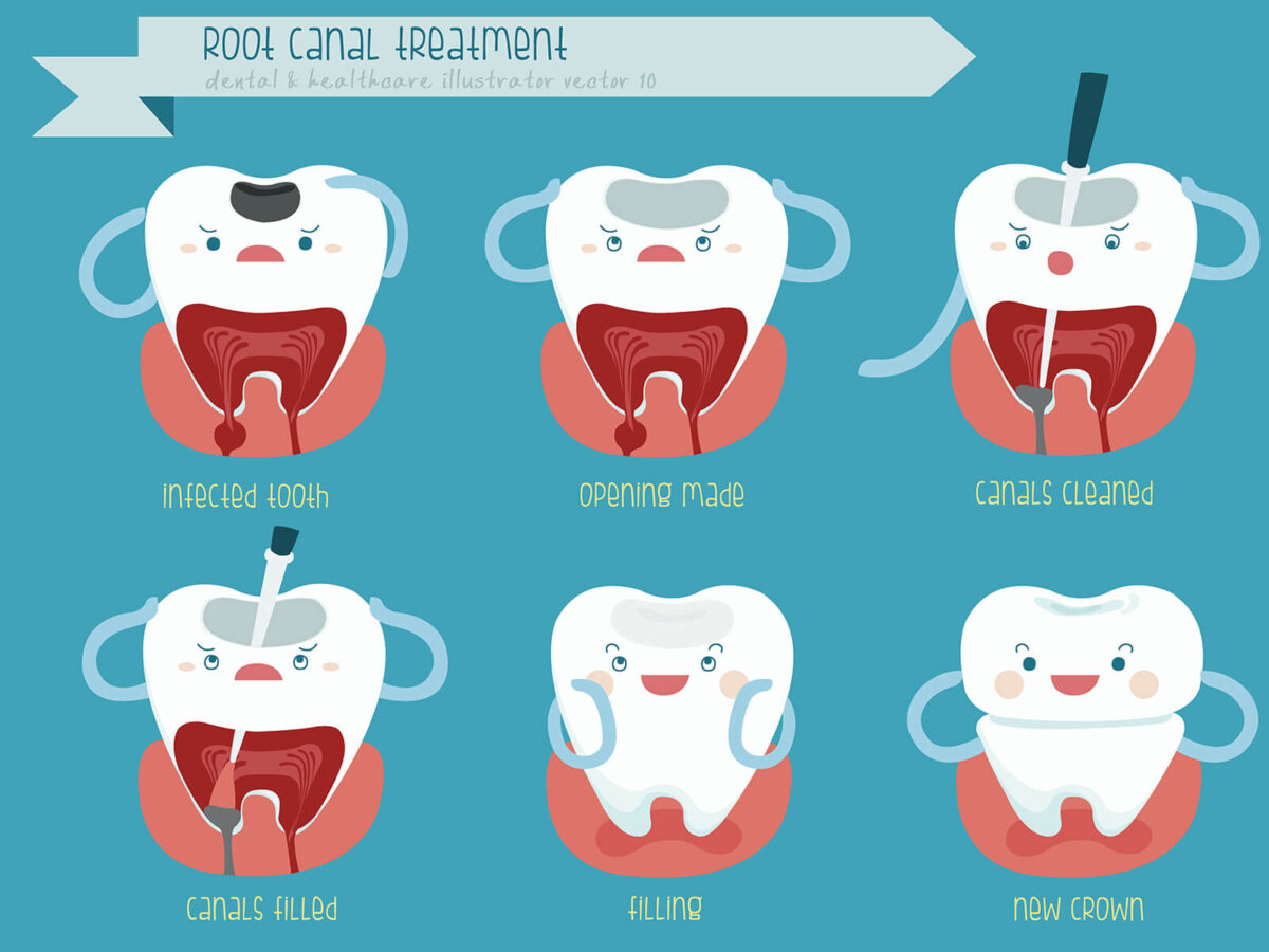 Root Canal Therapy