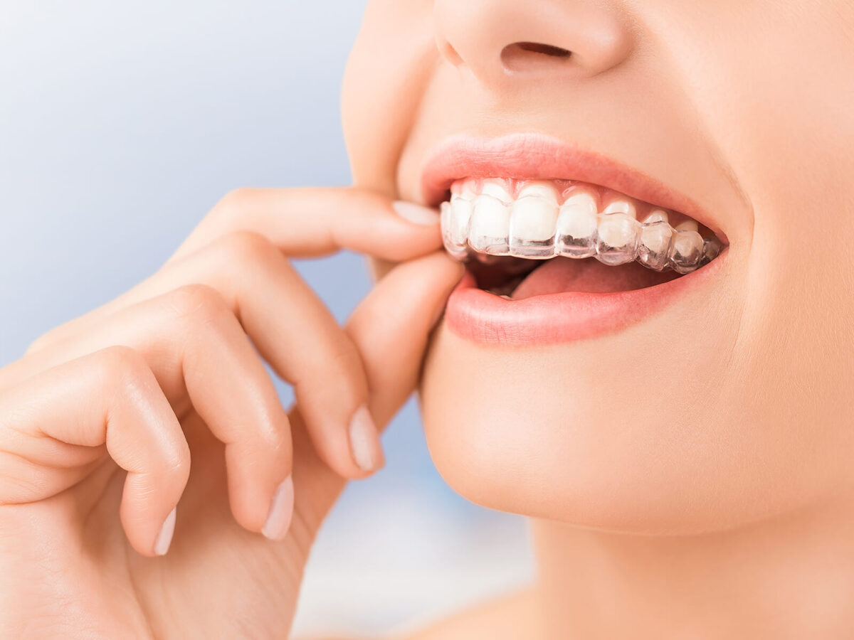 Top 5 Reasons To Consider Invisalign