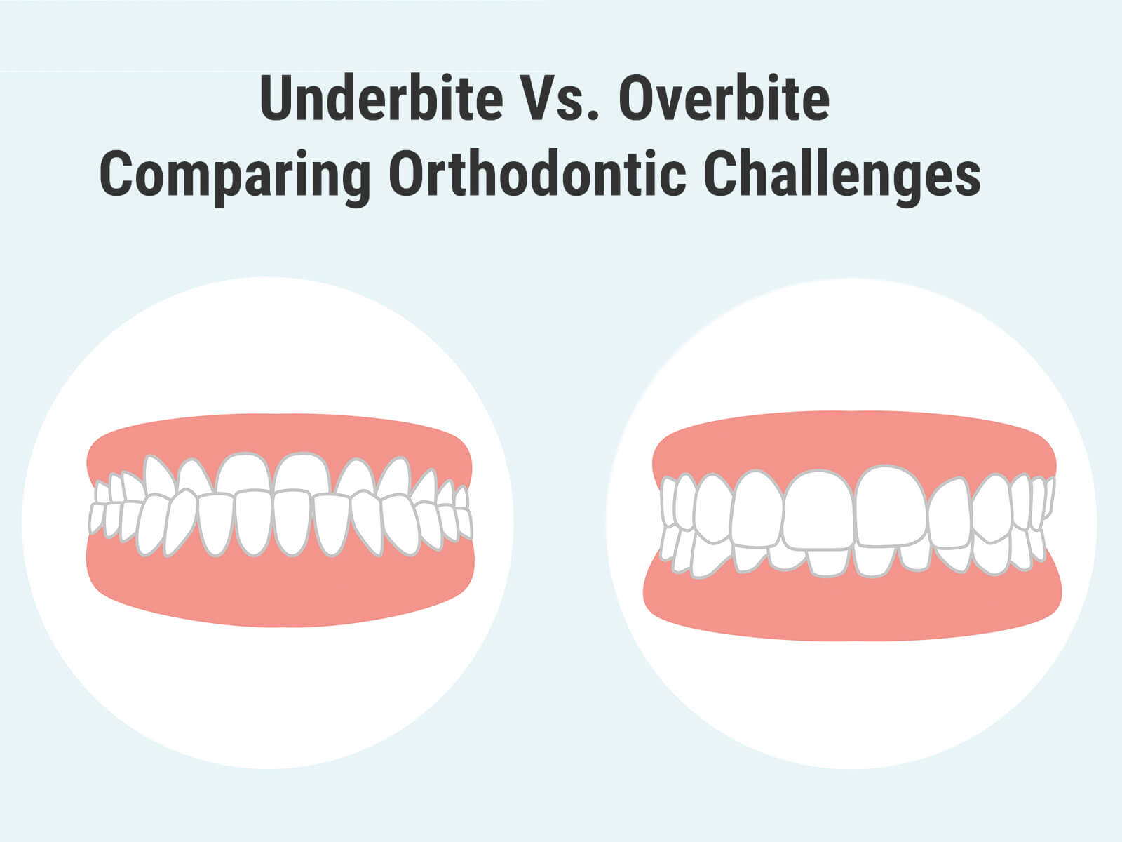 Differentiating Major Bite Problems: Overbite Vs Underbite