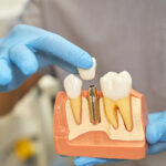 The Long-Term Benefits of Dental Implants for Oral Health