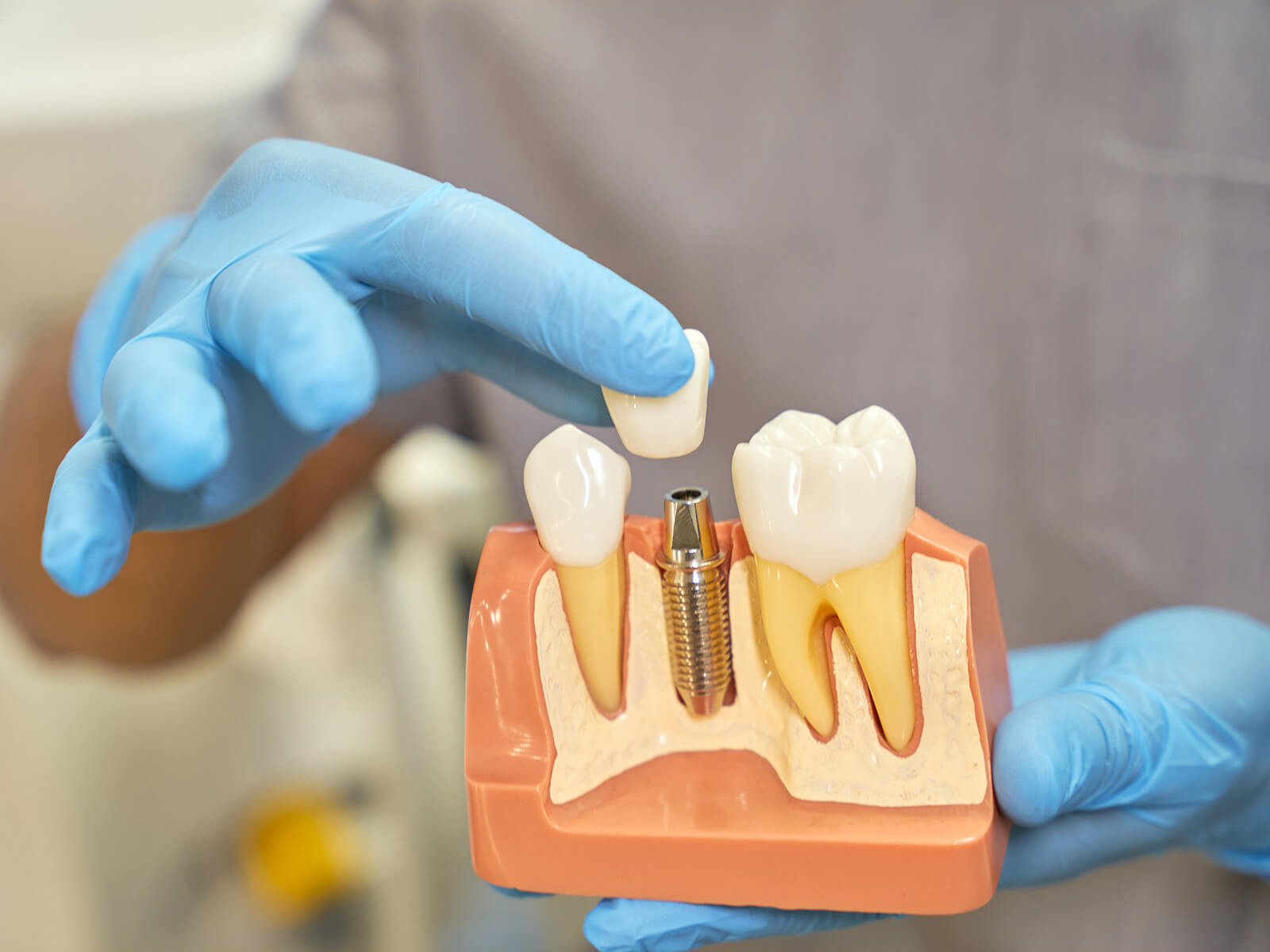 The Long-Term Benefits of Dental Implants for Oral Health