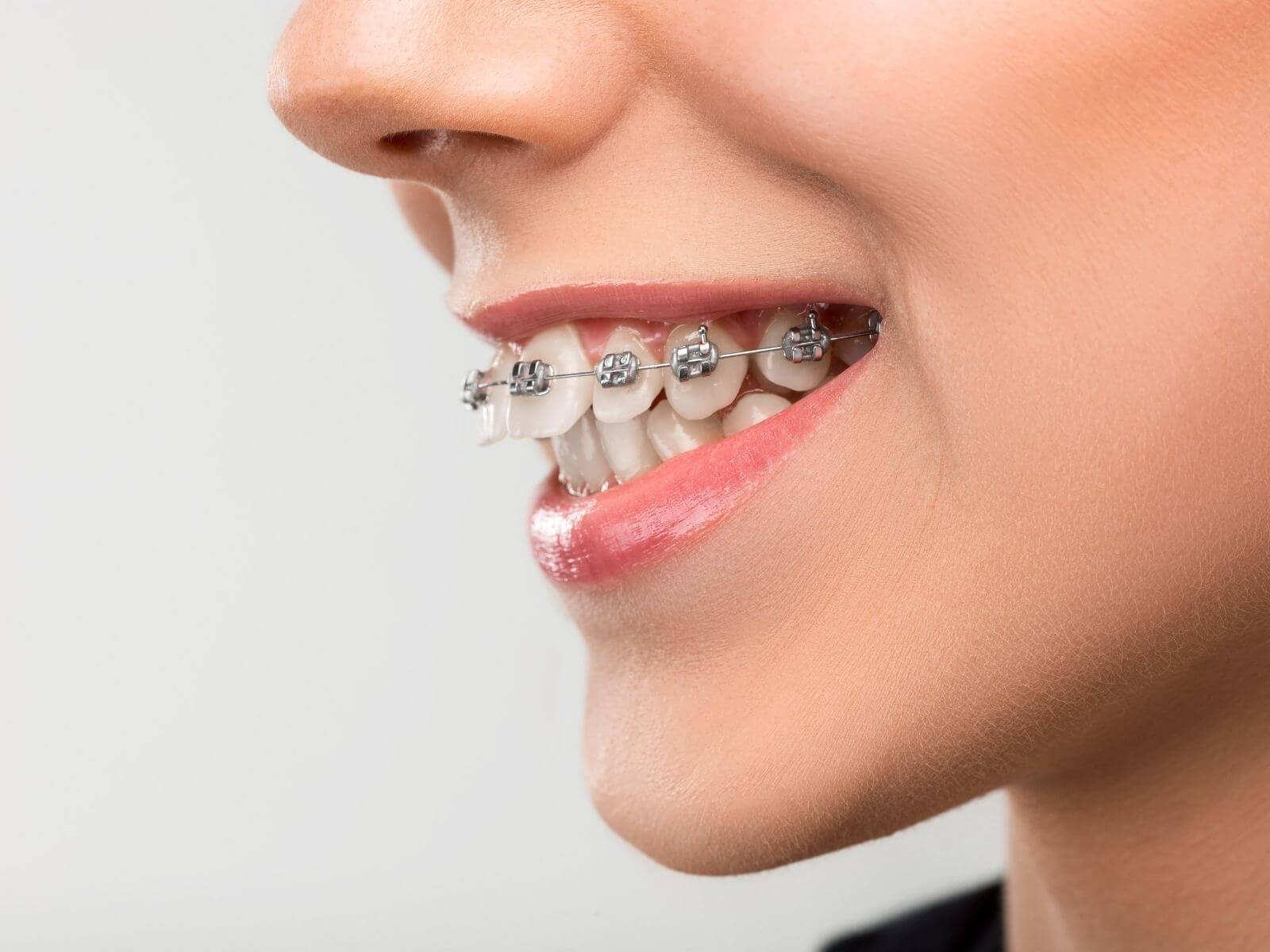 The Benefits of Early Orthodontic Treatment